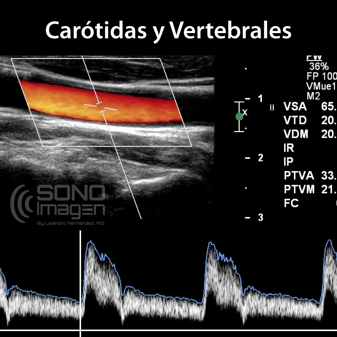 Doppler de Carótidas y Vertebrales