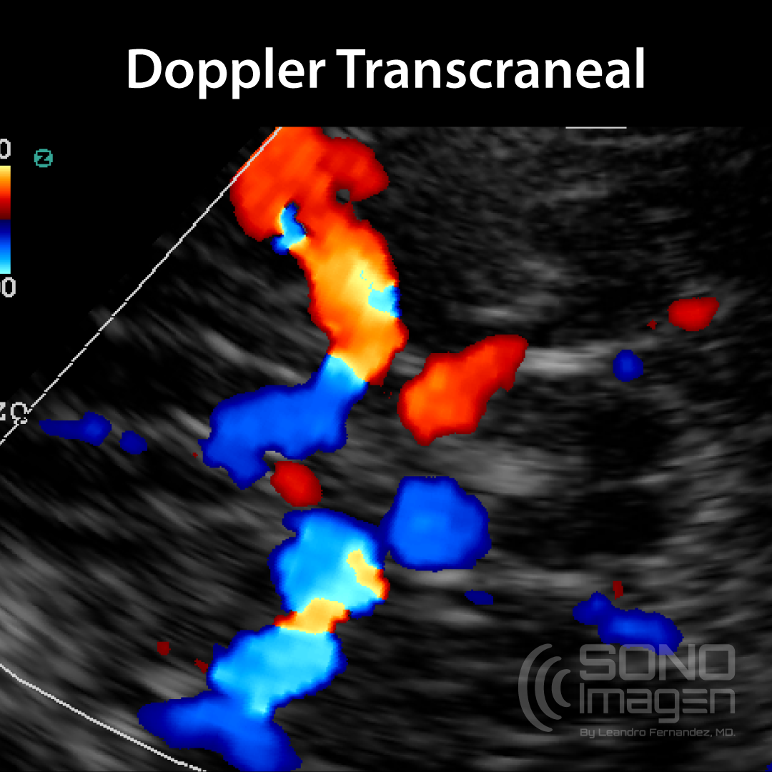 Curso Doppler Transcraneal